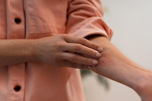 Can A Healthy Gut Reverse Eczema Flares in Winter preview
